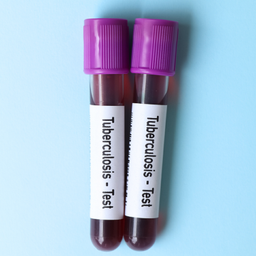 Two vials of blood with stickers on them that say Tuberculosis test