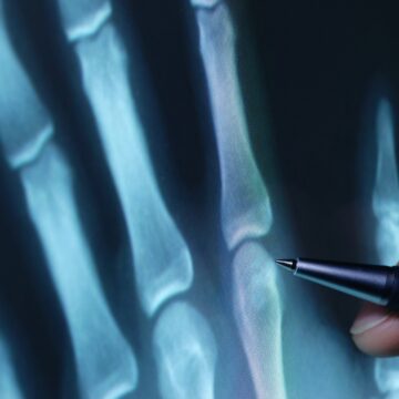 Picture of a medical provider pointing to a spot on an X-ray of a hand.