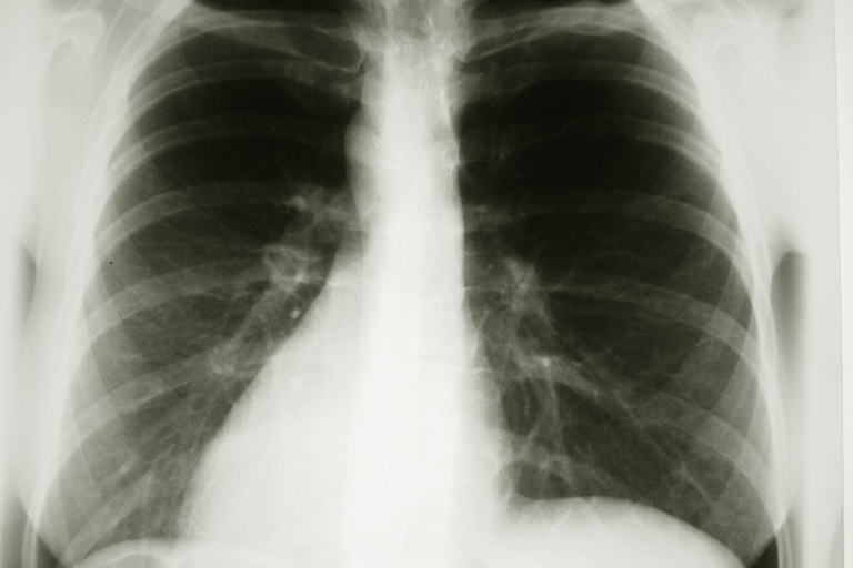 Picture of a chest X-ray.